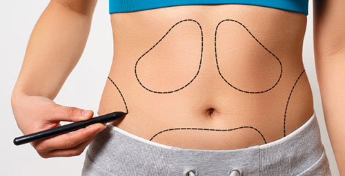 Abdominoplasty